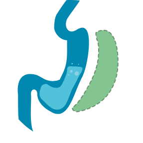 Gastric sleeve illustration