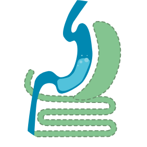 Duodenal switch illustration
