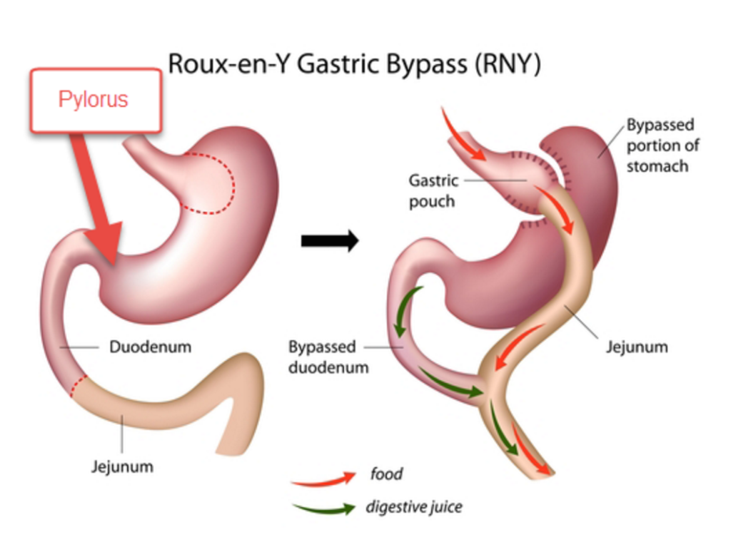 gastric bypass graphic