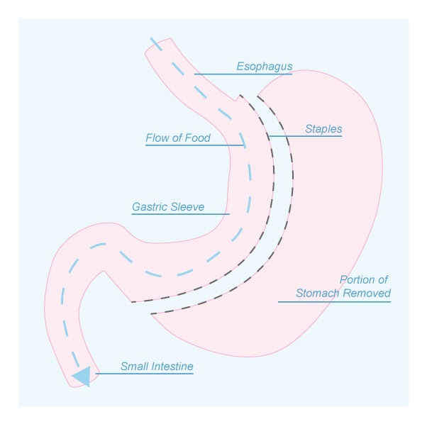 gastric sleeve
