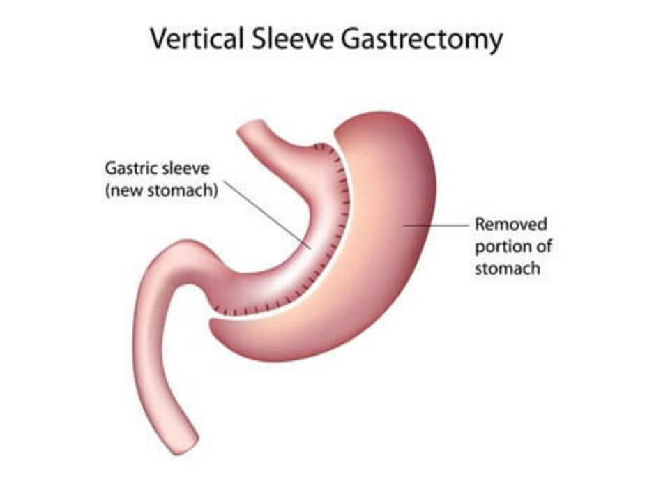 gastric sleeve graphic