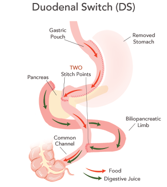duodenal switch